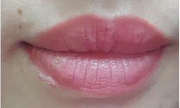 Cảnh b&#225;o nhiễm herpes khi xăm m&#244;i