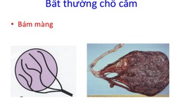 Nguy cơ d&#226;y rốn b&#225;m m&#224;ng c&#243; ảnh hưởng đến thai nhi