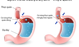 Cải thiện tr&#224;o ngược dạ d&#224;y – thực quản