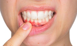 Cảnh b&#225;o: Những bệnh tật li&#234;n quan đến răng nướu