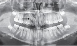 Những dấu hiệu gợi &#253; răng ngầm v&#224; điều trị