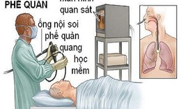 Đ&#227;  r&#245; nguy&#234;n nh&#226;n tử vong của bệnh nh&#226;n nội soi phế quản tại BV Bạch Mai