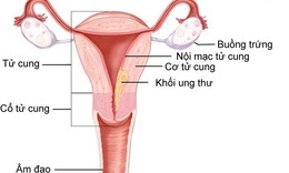 Qu&#225; sản nội mạc tử cung tiến triển th&#224;nh ung thư v&#236; kh&#244;ng điều trị sớm