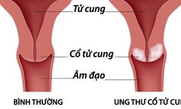 Quan hệ t&#236;nh dục từ năm 16 tuổi, c&#244; g&#225;i mắc ung thư cổ tử cung khi mới 24 tuổi
