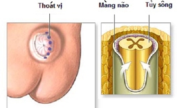 Tho&#225;t vị m&#224;ng n&#227;o tủy