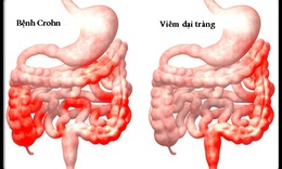 5 c&#225;ch giảm triệu chứng bệnh Crohn kh&#244;ng cần thuốc