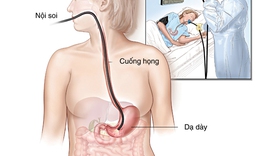 Cẩn thận khi bị polyp dạ d&#224;y