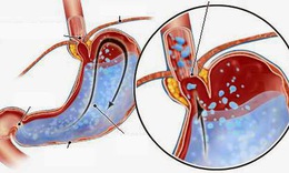 Để d&#249;ng t&#244;i giảm acid dạ d&#224;y an to&#224;n