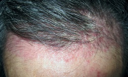 Trị rụng t&#243;c do nấm, thuốc g&#236;?