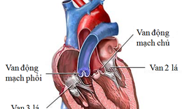 Nguy&#234;n nh&#226;n g&#226;y hở van tim