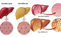 Gan nhiễm mỡ c&#243; nguy hiểm kh&#244;ng?