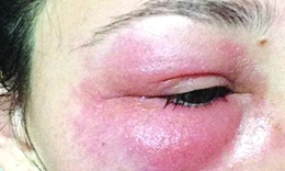 Mùa mưa, thận trọng với bệnh da tiếp xúc do côn trùng