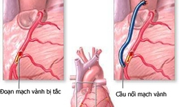 Những nguy cơ gặp phải khi bị cầu cơ động mạch v&#224;nh