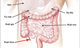 Những biến chứng nguy hiểm do vi&#234;m ruột thừa