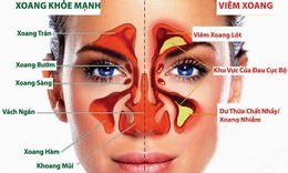 Ðông y chữa viêm mũi mạn tính