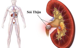 Sỏi thận to điều trị thế n&#224;o?