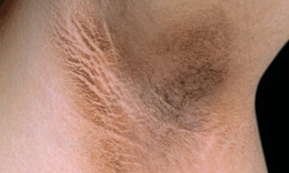 Acanthosis Nigricans là bệnh gì?