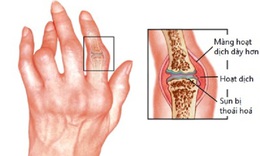 B&#224;i thuốc trị sưng đau c&#225;c khớp