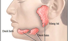 V&#244;i h&#243;a tuyến nước bọt - Nguy hiểm nhưng dễ bị bỏ qua