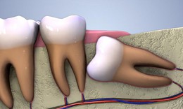 C&#225;c biến chứng do răng kh&#244;n mọc lệch ngầm