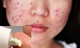 Các thuốc không được lạm dụng khi trị trứng cá đỏ