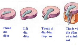 Ph&#236;nh đĩa đệm c&#243; nguy hiểm?