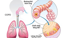 Bệnh phổi tắc nghẽn mạn t&#237;nh c&#243; thể ph&#242;ng ngừa?