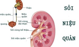 Sỏi niệu quản c&#243; nguy hiểm?