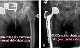 Biến chứng sau mổ thay khớp h&#225;ng&#160;