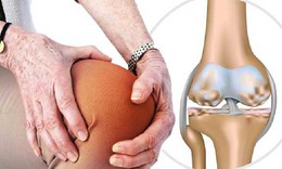 Cách trị tho&#225;i h&#243;a khớp gối kh&#244;ng d&#249;ng thuốc