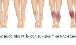 B&#224;i tập cho người suy gi&#227;n tĩnh mạch ch&#226;n