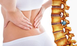 Dấu hiệu nhận biết thoát vị đĩa đệm vùng thắt lưng