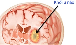 U n&#227;o &#225;c t&#237;nh chứa tế b&#224;o ung thư