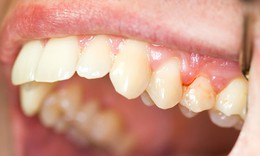 Mầm bệnh gây bệnh nha chu có thể cản trở khả năng thụ thai ở phụ nữ