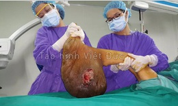 BV Việt Đức: &#39;Giải cứu&#39; người phụ nữ mang khối u khổng lồ 10kg r&#242;ng r&#227; gần 40 năm