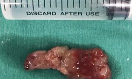 Đau lưng dai dẳng, nữ thanh niên có khối u chiếm toàn bộ lòng ống tuỷ