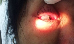 Một phụ nữ vỡ nh&#227;n cầu v&#236; bị chồng bạo h&#224;nh