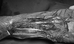 Ngón tay bỗng dưng không duỗi được, cụ bà bị đứt gân mà không hề hay biết