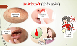 B&#225;c sĩ chỉ r&#245; 2 biến chứng nguy hiểm của sốt xuất huyết, dấu hiệu cảnh b&#225;o cần đến viện ngay