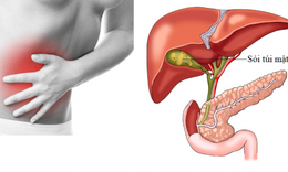 Biến chứng kh&#243; lường nếu kh&#244;ng chữa sỏi mật, người d&#226;n n&#234;n kh&#225;m sức khỏe thường xuy&#234;n