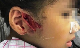 H&#224; Nội: Ch&#243; nh&#224; b&#224; ngoại cắn r&#225;ch mặt, tay b&#233; trai dịp nghỉ lễ