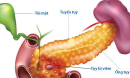 Nguyên nhân gây viêm tụy mạn tính