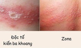 B&#225;c sĩ chỉ c&#225;ch ph&#226;n biệt vết đốt do kiến ba khoang với bệnh zona, nhiều người hay nhầm lẫn