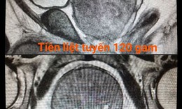 Cứu cụ &#244;ng c&#243; khối tiền liệt tuyến &quot;si&#234;u to, khổng lồ&quot; khỏi chứng tiểu đ&#234;m