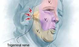 Đau d&#226;y thần kinh số V - Cơn đau dữ dội như &quot;chết đi sống lại&quot;