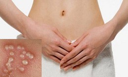 C&#225;ch n&#224;o ph&#242;ng ngừa Herpes sinh dục t&#225;i ph&#225;t?