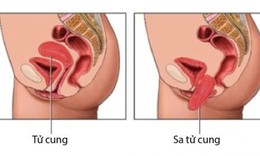 Phương ph&#225;p thuốc qu&#253; đẩy l&#249;i tận gốc sa tử cung