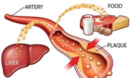 Thảo dược chuyên biệt cho những người bị máu nhiễm mỡ