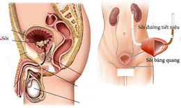 Sỏi b&#224;ng quang - Những ch&#250; &#253; kh&#244;ng thể bỏ qua