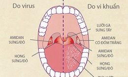 Kh&#225;ng vi&#234;m, ti&#234;u vi&#234;m - mấu chốt ph&#242;ng và đ&#226;̉y lùi vi&#234;m họng, vi&#234;m amidan